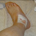 foot-injury1
